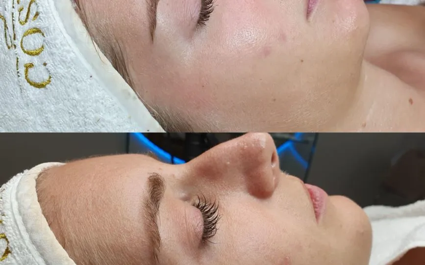 Aqua Peeling Behandlung
