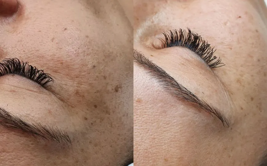 Microneedling Behandlung